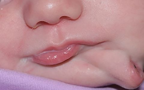 Děvčátko se narodilo se dvěma ústy: Díky moderní medicíně je nyní zcela zdravé!