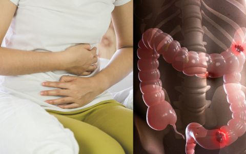 Rakovina tlustého střeva: Třetí nejčastější zabiják moderní doby