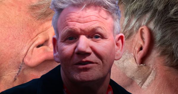 Gordon Ramsay přiznal boj s rakovinou kůže: Podstoupil operaci a varuje fanoušky