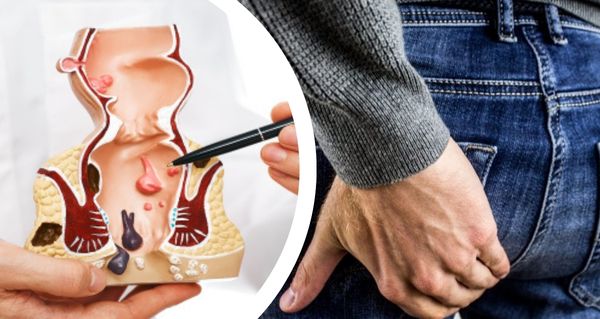 Hemoroidy trápí více než polovinu lidí. Proč třetina problém neřeší?